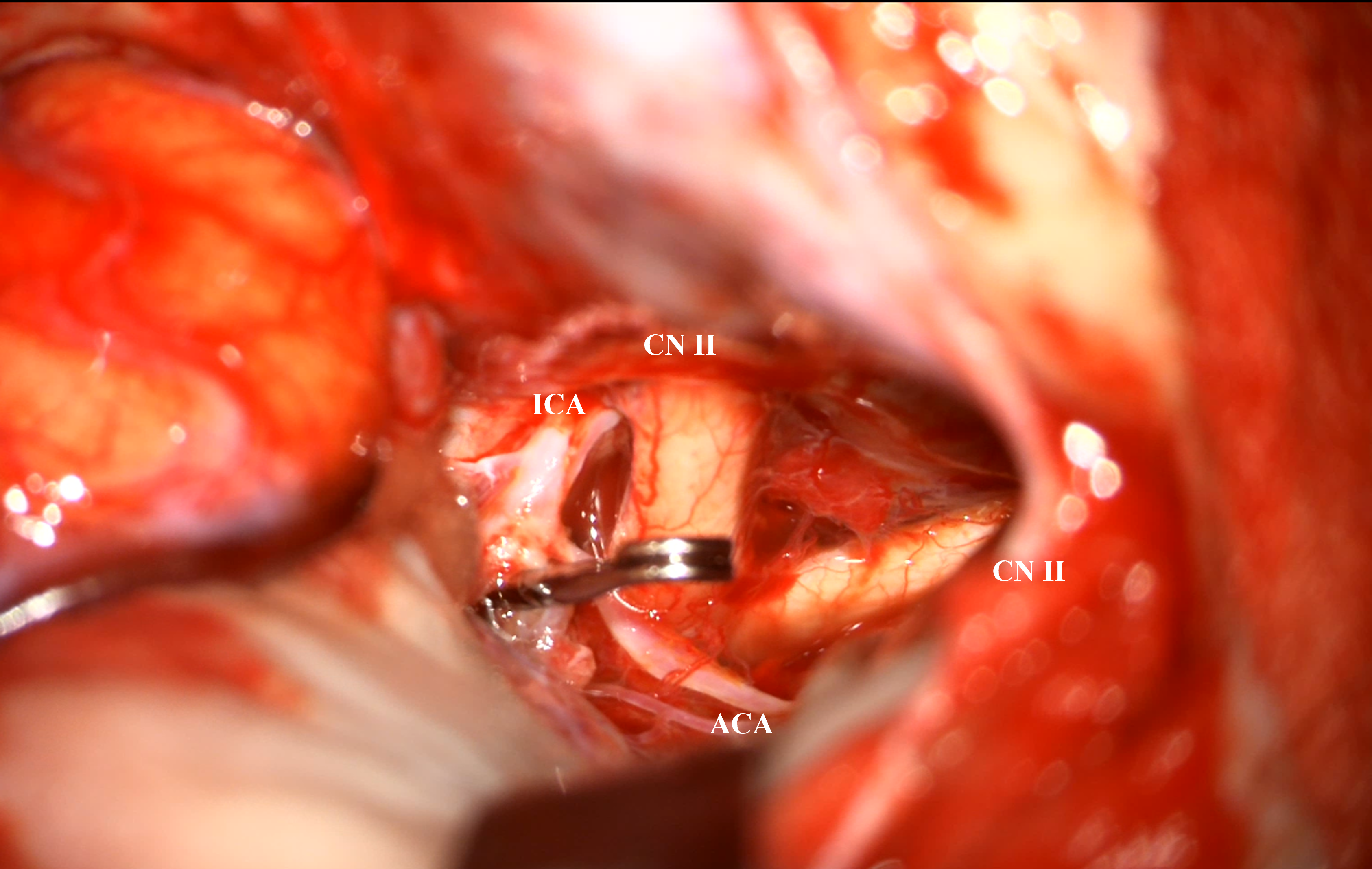 Figure 8. Intraoperative view of the ICA bifurcation aneurysm.]